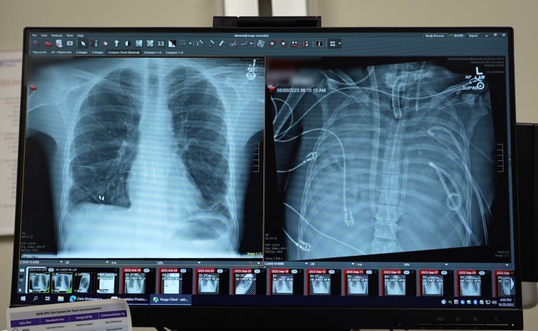 Scans show Davey Bauer's new lungs, left, and old lungs filled with puss.