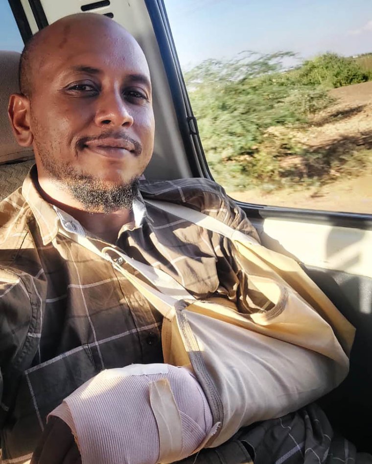 Amr Ali after receiving treatment for his hand, which was broken when he was beaten in RSF captivity.