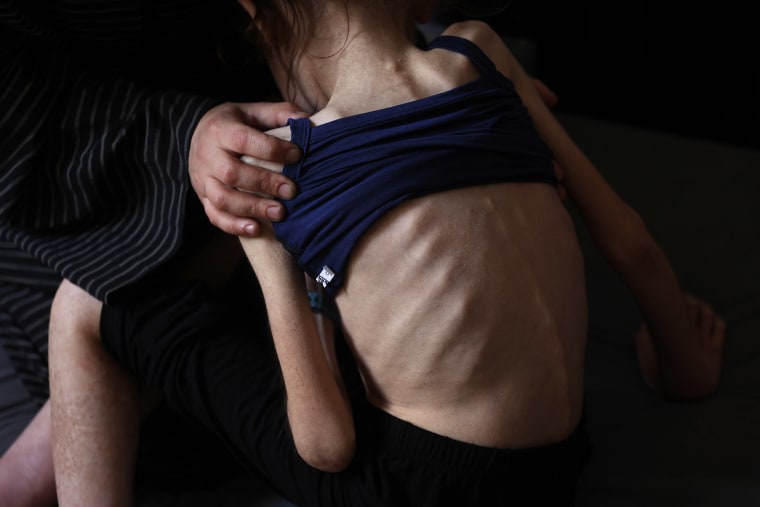 The back of a 12 year old girl showing her protruding ribs.