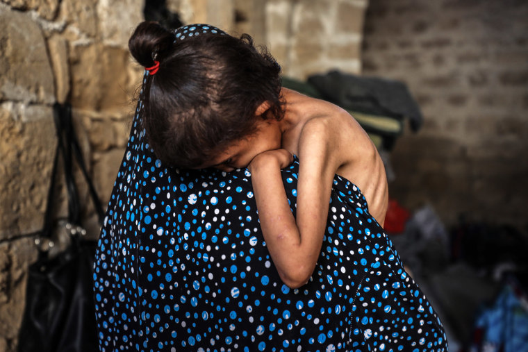 Islam Hajjaj holds her 6-year-old daughter Najwa, who suffers from malnutrition