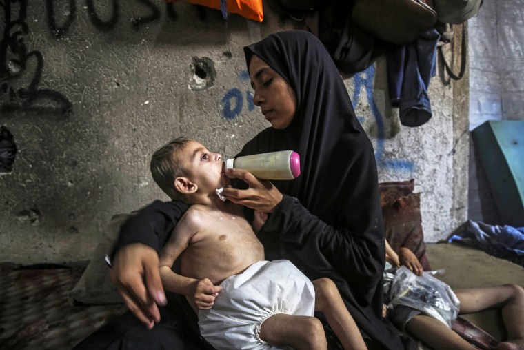 Two Palestinian brothers suffer from malnutrition amid Israeli attacks on Gaza