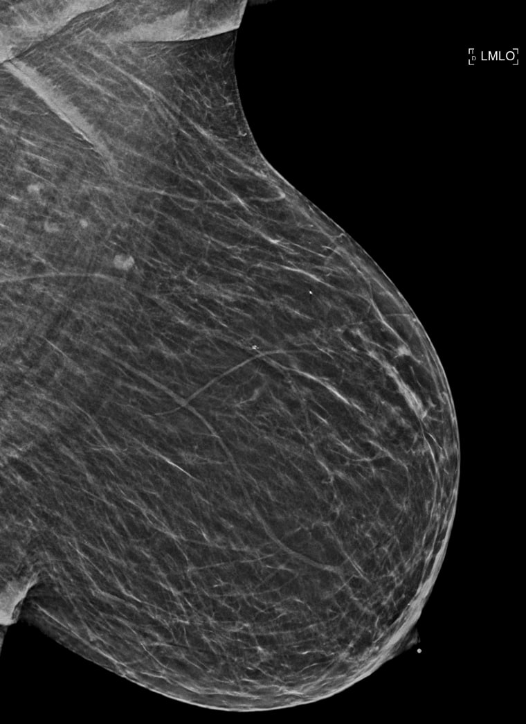 A black and white mammogram showing breast calcification